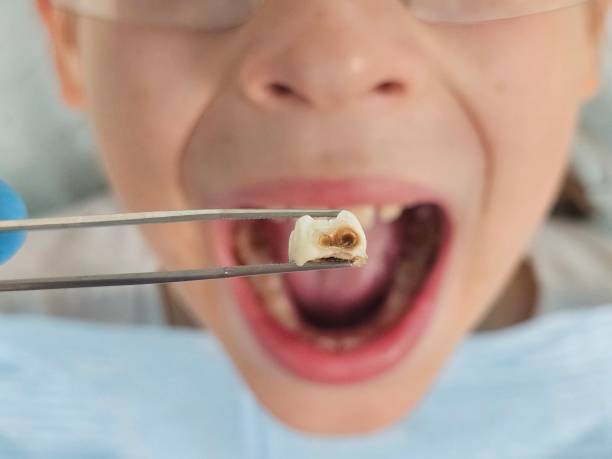 Best Emergency Tooth Extraction in Copeland, OK